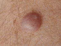 Cutane inflammatoire myofibroblastaire tumor