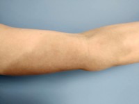 Cutane siderosis na extravasatie van ijzerinfusie