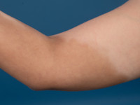 Cutane siderosis na extravasatie van ijzerinfusie