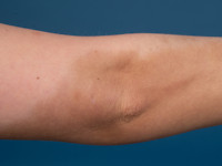 Cutane siderosis na extravasatie van ijzerinfusie