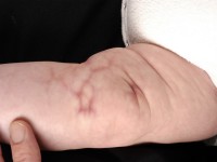 Cutis marmorata telangiectatica congenita (CMTC)