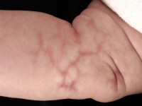 Cutis marmorata telangiectatica congenita (CMTC)