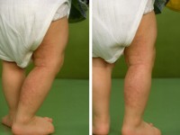 Cutis marmorata telangiectatica congenita (CMTC)