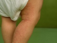 Cutis marmorata telangiectatica congenita (CMTC)