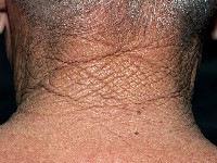 Cutis rhomboidalis nuchae