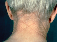 Cutis rhomboidalis nuchae