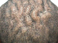 Cutis verticis gyrata