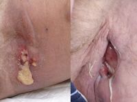 Corynebacterium jeikeium