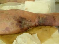 Anti-fosfolipiden syndroom