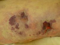 Anti-fosfolipiden syndroom