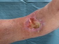 Arterio-veneuze fistel