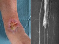 Arterioveneuze fistel