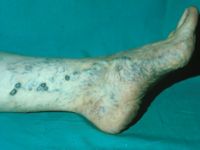 Insufficiënte venae communicantes, blow-outs