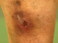Erythema induratum Bazin