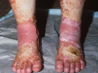 Erytromelalgia