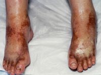 Erytromelalgia