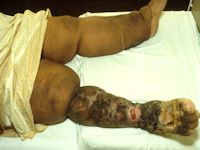 Lymfoedeem door filariasis
