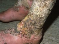 Lymfoedeem door filariasis