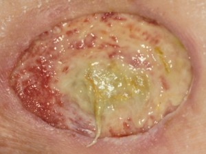 A wound that is still largely covered with yellow dead tissue