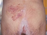 Herpes simplex