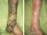 Hyperkeratose bij veneuze insufficientie