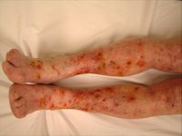 Keratosis actinica