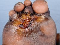 Neuropathische voet bij lepra