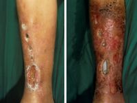 Osteosynthese materiaal