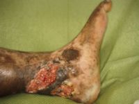 Plaveiselcelcarcinoom ontstaan in een chronisch ulcus