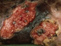 Plaveiselcelcarcinoom ontstaan in een chronisch ulcus