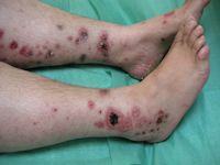 Polyarteritis nodosa