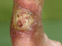 Ulcus bij reumatoide artritis