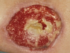 A wound that slowly begins to turn red due to the formation of new blood vessels (granulation tissue)