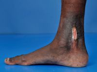 Ulcus bij sikkelcel anemie