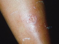 Ecthyma gangrenosum door Pseudomonas sepsis