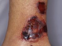 Leukocytoclastic vasculitis