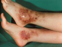 Leukocytoclastic vasculitis