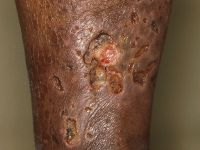 Leukocytoclastische vasculitis