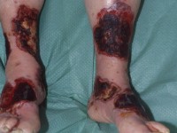 Factor V-Leiden deficiëntie