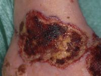 vasculitis en Factor V Leiden