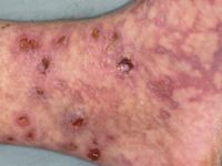 vasculitis en Factor V Leiden