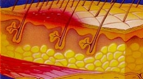 Graad 2 decubitus (oppervlakkige blaar of ontvelling)