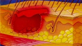 Graad 3 decubitus (huiddefect met schade of necrose van huid en onderhuids weefsel)