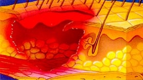 Graad 4 decubitus (diepe necrose tot aan vitale structuren)