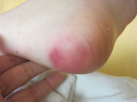 Graad 1 decubitus (niet wegdrukbaar erytheem)