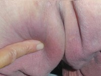 Grade 1 pressure ulcer (non-blanchable erythema)