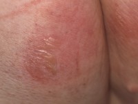 Grade 2 pressure ulcer (blister)