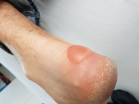 Graad 2 decubitus (blaar)