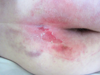 Grade 2 pressure ulcers (excoriation)