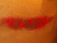 Graad 2 decubitus (ontvelling)